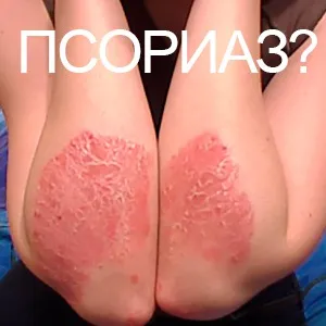 Море и псориазис може да бъде да се отърве от проблема в курорта