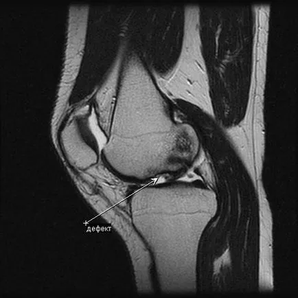 MRI a térd meniscus