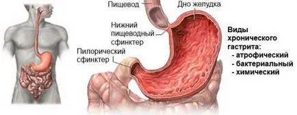 Традиционните методи за лечение на хроничен гастрит