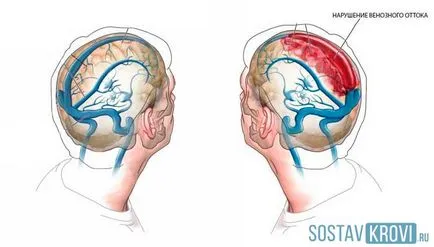 Violarea cerebrale simptome de scurgere venoase, tratament, copii, exercitarea