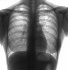 tuberculoza pulmonara Focal - diagnostic diferențial