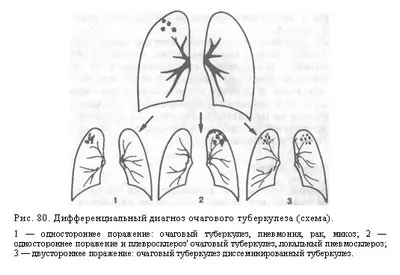 tuberculoza pulmonara Focal - diagnostic diferențial