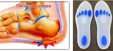 tălpi interioare ortopedice cu pinten toc, alegerea