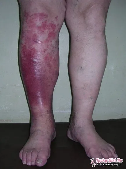 Zsibbadás bőrfelületre helyezze a lábát