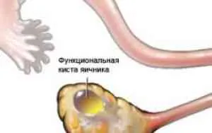 Tratamentul folicular ovarian chist de remedii populare - boli ale sistemului genito-urinar - catalog