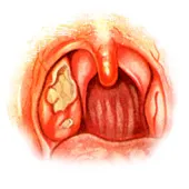 amigdalită acută (angina) - este o boală infecțioasă acută caracterizată prin