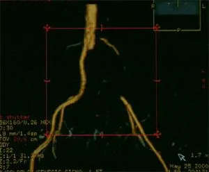 Tromboza acută (embolie) Tratamentul la nivelul membrelor arteriale, simptome