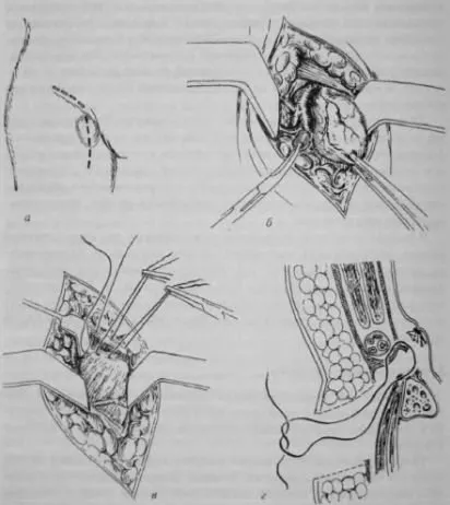 Caracteristici hernii femurale