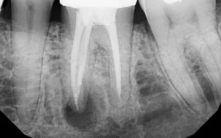 Akut periodontitis (beleértve az apikális - apikális) okoz, a diagnózis, a kezelés és a