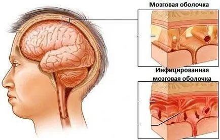 мозъчен оток причини, симптоми, лечение