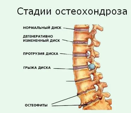 Osteochondrosis - Centru RMN