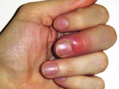 Panarițiu degetul pe un tratament de mână cu terapie tradițională și populară