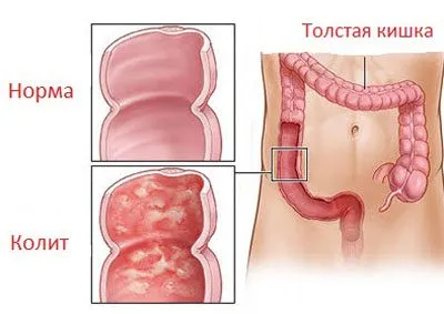 simptome de supradozaj de cocaină, efectele