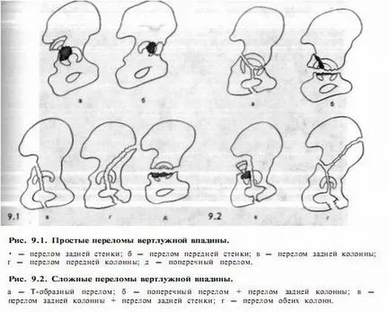 Счупване на ацетабулума причинява, на лечение, последствията и възстановяване, инвалидност