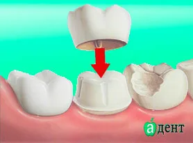 Пластмасови корони достойнство, производство и монтаж на пластмасови коронки
