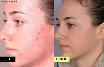 Peeling acizi din fructe Face comentarii, preț, clipuri video, fotografii înainte și după procedura de la domiciliu