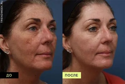 Peeling acizi din fructe Face comentarii, preț, clipuri video, fotografii înainte și după procedura de la domiciliu