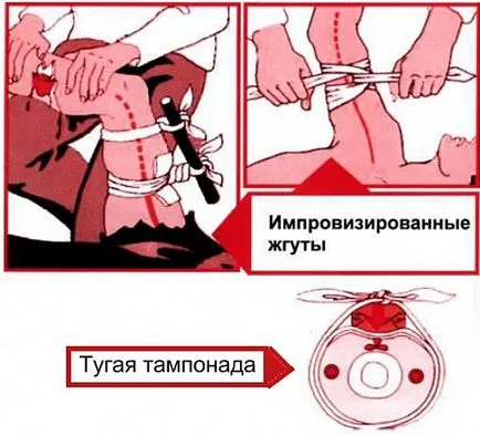 Първа помощ за артериално кървене по точките от предмишницата, хип, бедрената артерия