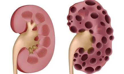 диета поликистоза бъбречно заболяване, хранене, витаминни комплекси
