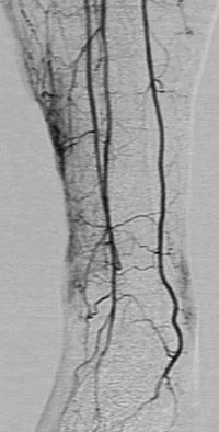 Post-trombotic boala - cauze, simptome, diagnostic și tratament