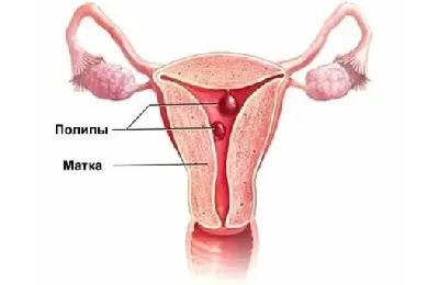 Polip in tratamentul uterului fara chirurgie si chirurgie, poate fi vindecată