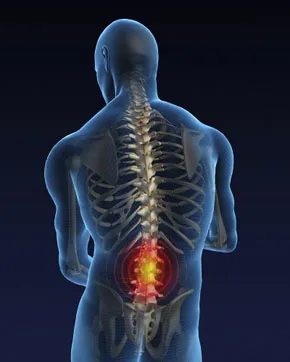 Tratamentul osteocondrozei lombare de boli degenerative de disc lombare