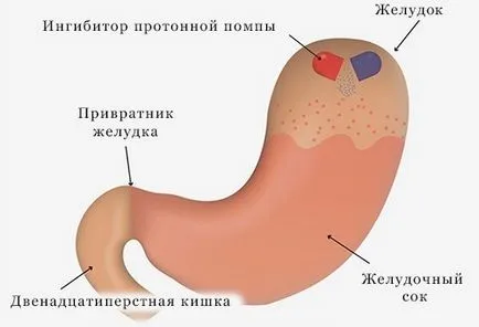 Повърхностен гастрит необходимо лечение и неговите възможни схеми