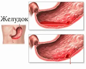 Perforált (perforált) peptikus fekély tünetek és a kezelés