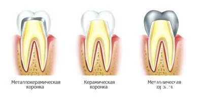 Protézisek implantátumokra költsége, mérföldkövek és képek