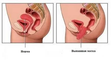 Boala prolaps genital, care pot și trebuie să fie tratate