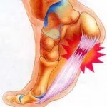 Calcaneus homlok rehabilitáció