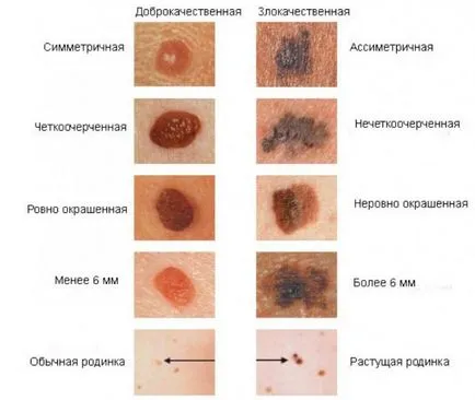 Simptomele cancerului de piele si semne cu fotografii, tipuri, etape și tratament