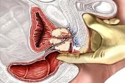 simptome HBP, diagnostic și tratament