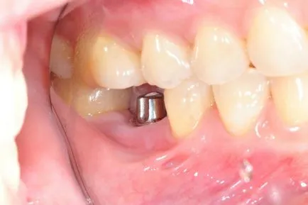 Edentulous зъболечение, причини, симптоми, видове, диагностика и профилактика