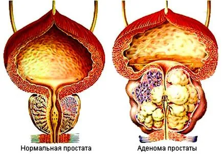 simptome HBP, diagnostic și tratament