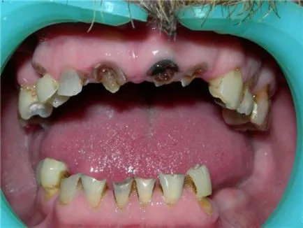 Fogatlan fogászati ​​kezelés, okai, tünetei, típusai, a diagnózis és megelőzés