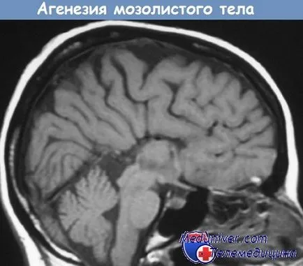 Corpus callosum agenesia - klinikai kép, diagnózis, kezelés