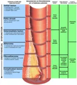 Atherosclerosis hibás fertőzések - Articole