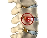 Osteoarthritis az állkapocsízület tünetei és kezelése arthrosis temporomandibularis ?? - állkapocsízület (TMJ)