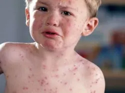 Allergiás édes gyermek