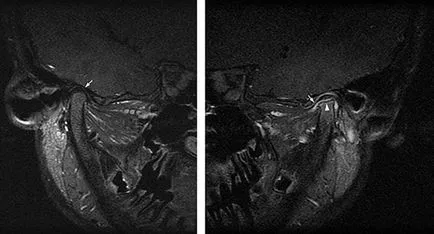 Osteoarthritis az állkapocsízület tünetei és kezelése arthrosis temporomandibularis ?? - állkapocsízület (TMJ)