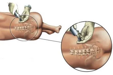 Érzéstelenítés császármetszéssel epidurális, spinális altatásban; érvek, ellenérvek és a lehetséges