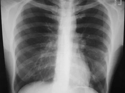 Pneumonie atipica - simptome si tratament, 1001 Consiliul de