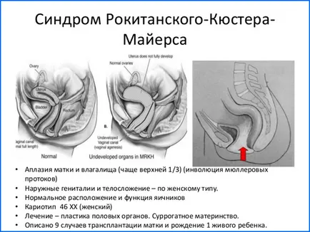 Аплазия на матката и причини за диагностициране на болестта, лечението