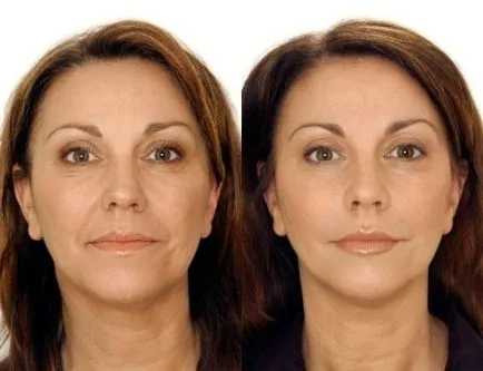 Diamond peeling „- Biztonságos arcfiatalítás