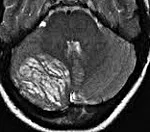 Lhermitte-Duklos boala - cauze, simptome, diagnostic și tratament