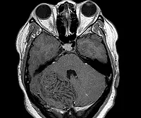 Lhermitte-Duklos boala - cauze, simptome, diagnostic și tratament