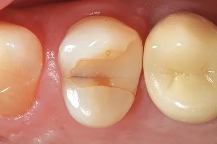 Durere de dinți după Clinica de Stomatologie plombirovaniyaredwhite Modern