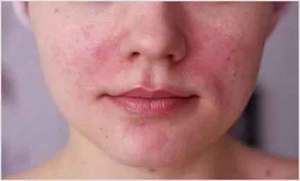 Arc tisztító rosacea, amely héjat lehet tenni