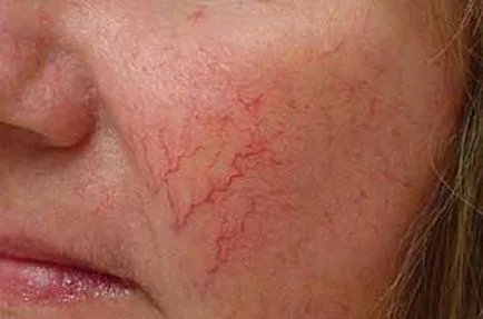 Arc tisztító rosacea, amely héjat lehet tenni